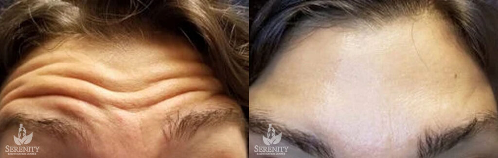 Botox Forehead Lines Seattle, Botox Bellevue, Forehead Wrinkle Redmond