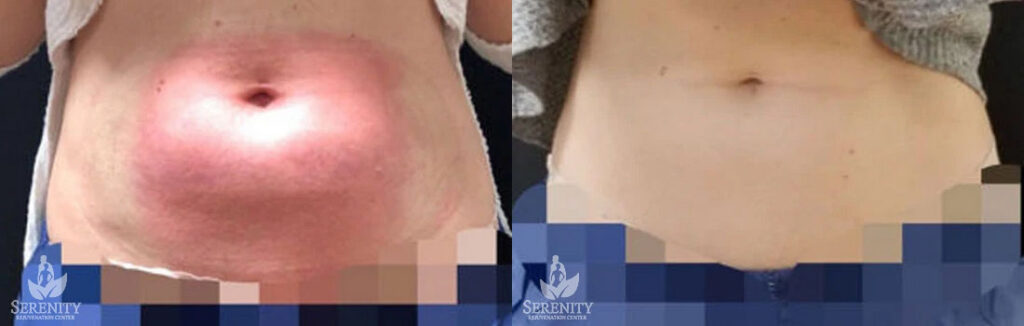 CoolSculpting Non Invasive Fat Reduction Seattle, Stomach Fat Freezing Bellevue, Body Sculpting Redmond