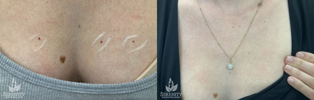 IPL Treatment before and after photo by Dr. Stephen O’Connell in Bellevue, WA