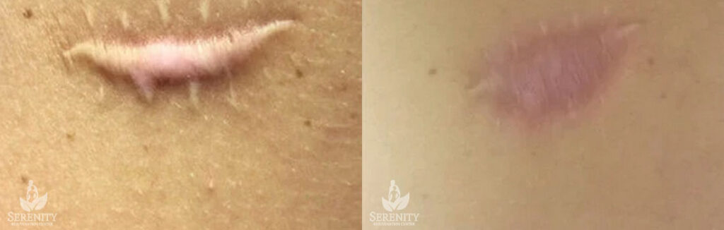 Keloid before and after photo by Dr. Stephen O’Connell in Bellevue, WA