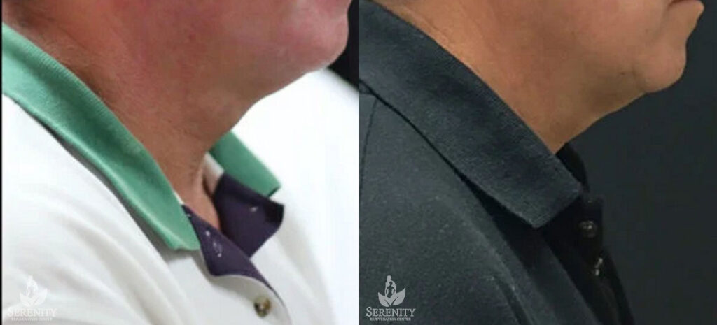 Kybella Double Chin Treatment in Bellevue & Seattle