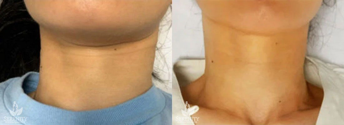 Potenza RF Microneedling in Seattle, Bellevue & Redmond