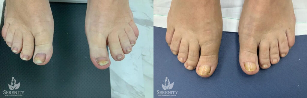 Toe Nail Fungus Protocol before and after photo by Dr. Stephen O’Connell in Bellevue, WA