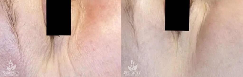 Botox before and after photo by Dr. Stephen O’Connell in Bellevue, WA