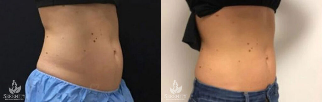 CoolSculpting before and after photo by Dr. Stephen O’Connell in Bellevue, WA