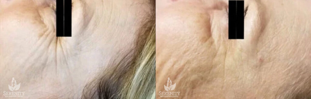 Botox before and after photo by Dr. Stephen O’Connell in Bellevue, WA