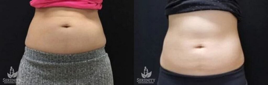 CoolSculpting before and after photo by Dr. Stephen O’Connell in Bellevue, WA