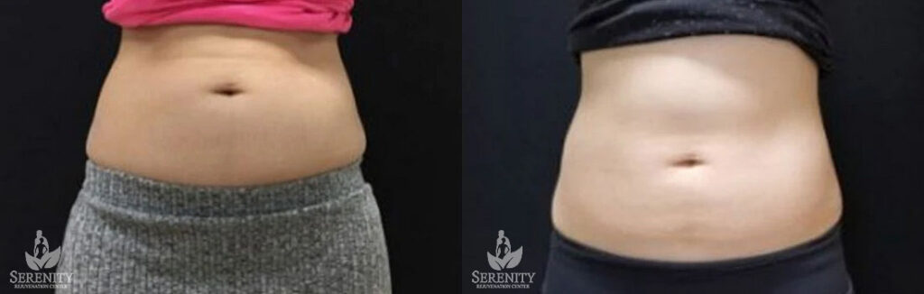 CoolSculpting Abdomen Fat Reduction Bellevue, Stubborn Fat Treatment Seattle, Body Contouring Redmond