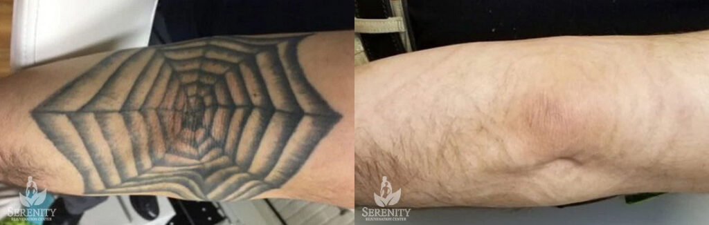 PicoSure Laser Tattoo Removal in Bellevue & Seattle