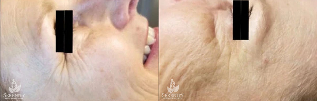 Botox before and after photo by Dr. Stephen O’Connell in Bellevue, WA