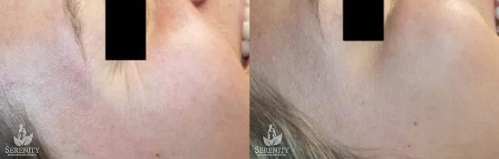 Botox before and after photo by Dr. Stephen O’Connell in Bellevue, WA