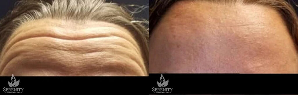 Botox before and after photo by Dr. Stephen O’Connell in Bellevue, WA