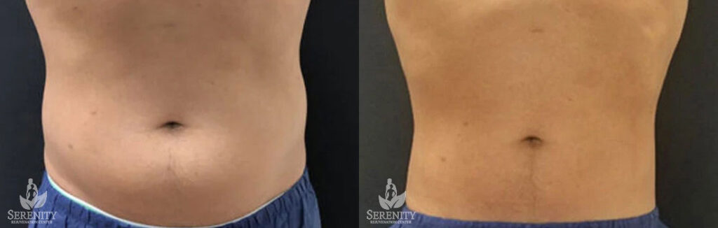 CoolSculpting Treatment Redmond, Fat Freezing Seattle, Non Surgical Body Sculpting Bellevue