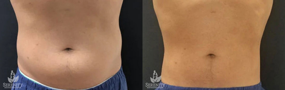 CoolSculpting before and after photo by Dr. Stephen O’Connell in Bellevue, WA