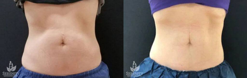 CoolSculpting before and after photo by Dr. Stephen O’Connell in Bellevue, WA