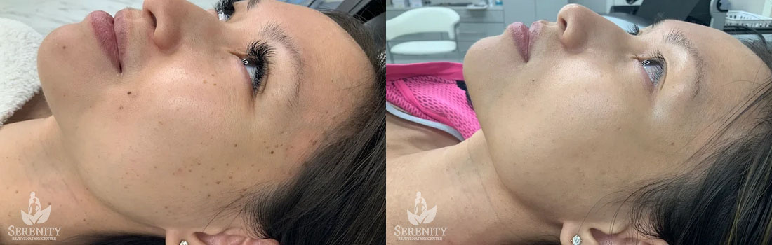 Advanced PicoFocus Laser in Bellevue & Seattle