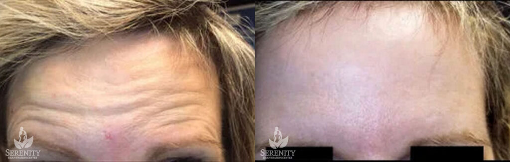 Botox before and after photo by Dr. Stephen O’Connell in Bellevue, WA