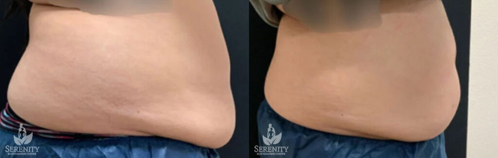 CoolSculpting Treatment Bellevue, Fat Reduction Seattle, Body Contouring Kirkland