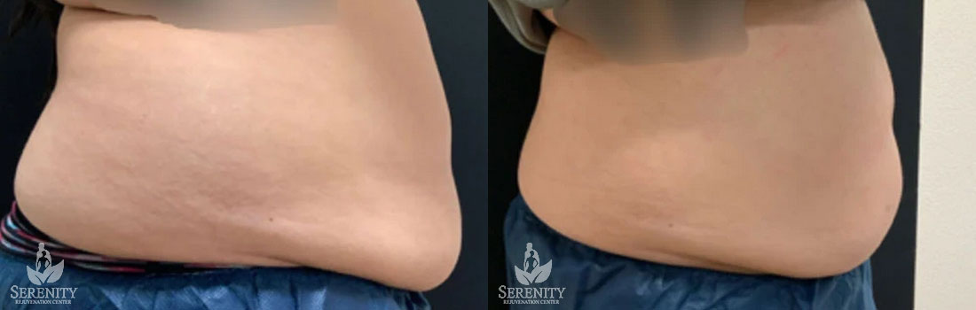 CoolSculpting Treatment Bellevue, Fat Reduction Seattle, Body Contouring Kirkland