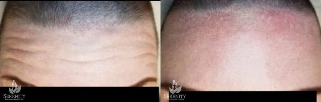 Botox before and after photo by Dr. Stephen O’Connell in Bellevue, WA