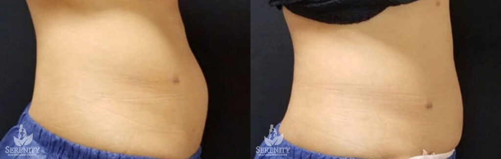 CoolSculpting before and after photo by Dr. Stephen O’Connell in Bellevue, WA