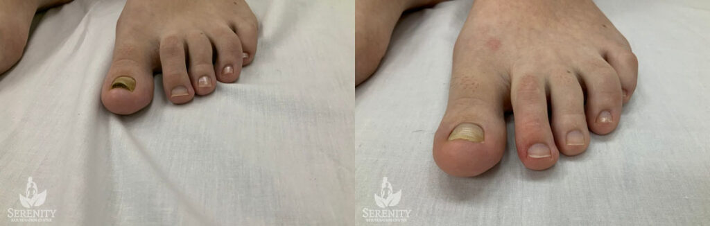 Toe Nail Fungus Protocol before and after photo by Dr. Stephen O’Connell in Bellevue, WA