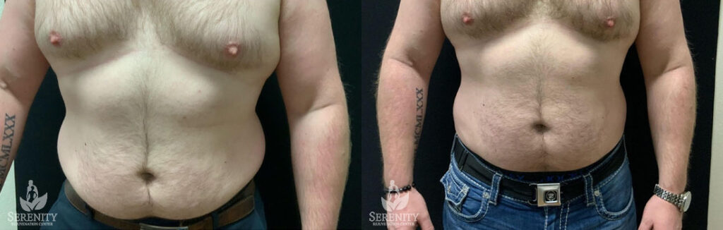 CoolSculpting before and after photo by Dr. Stephen O’Connell in Bellevue, WA