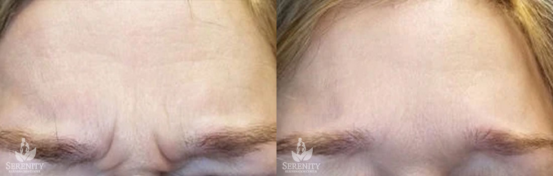 Botox before and after photo by Dr. Stephen O’Connell in Bellevue, WA