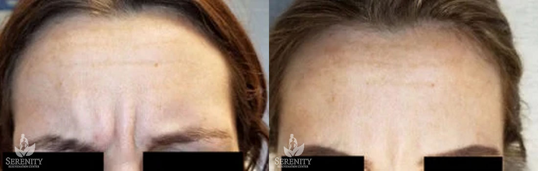 Botox before and after photo by Dr. Stephen O’Connell in Bellevue, WA