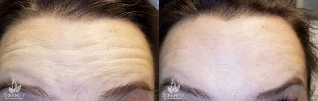 Botox before and after photo by Dr. Stephen O’Connell in Bellevue, WA