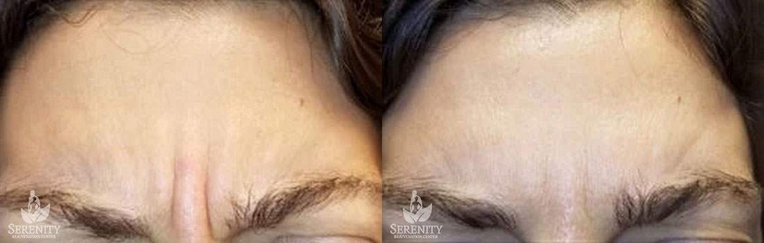 Botox before and after photo by Dr. Stephen O’Connell in Bellevue, WA