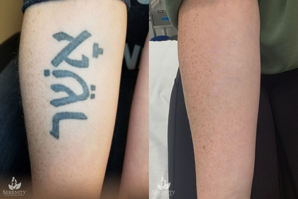 Clearer Skin with PicoSure Tattoo Removal – Bellevue & Seattle