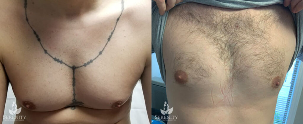 PicoSure Tattoo Removal before and after photo by Dr. Stephen O’Connell in Bellevue, WA