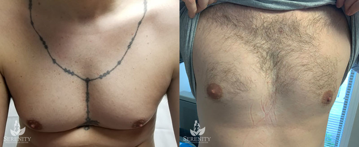 Best PicoSure Laser Tattoo Removal in Bellevue & Seattle