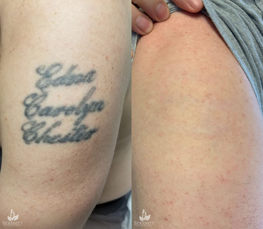 PicoSure Tattoo Removal before and after photo by Dr. Stephen O’Connell in Bellevue, WA