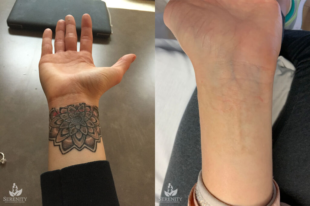 Best PicoSure Tattoo Removal Results in Bellevue & Seattle