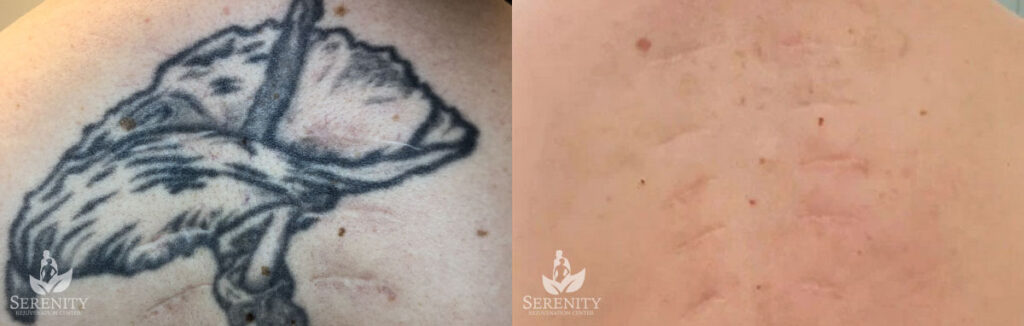 PicoSure Laser Tattoo Removal – Bellevue & Seattle