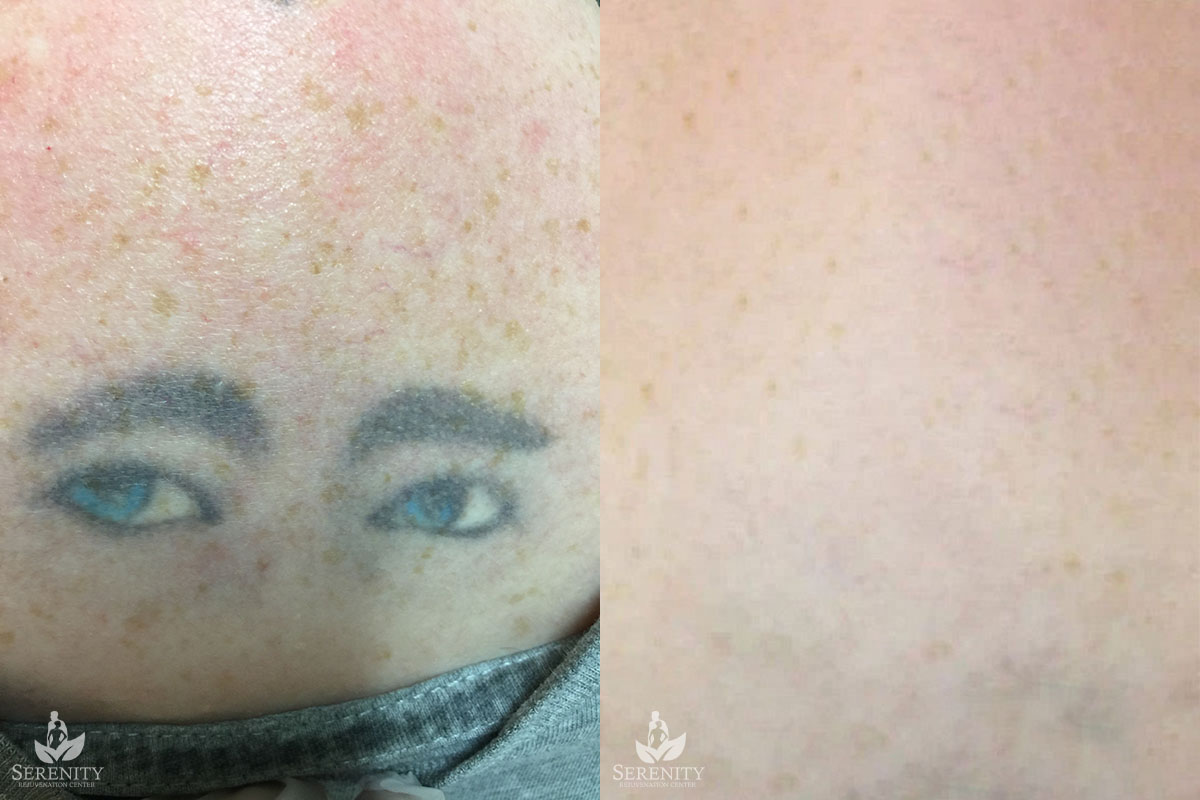 PicoSure Tattoo Removal before and after photo by Dr. Stephen O’Connell in Bellevue, WA