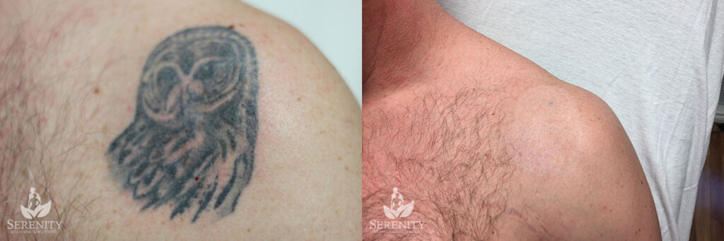 PicoSure Tattoo Removal before and after photo by Dr. Stephen O’Connell in Bellevue, WA