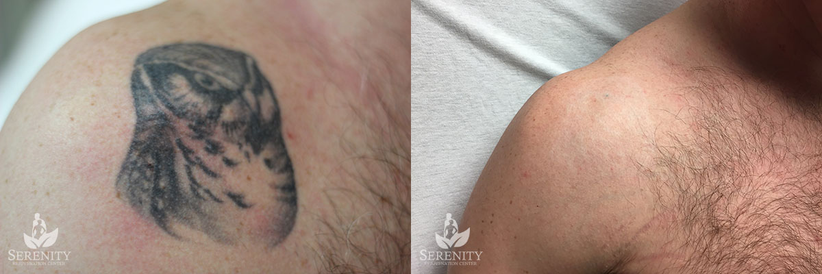 PicoSure Tattoo Removal before and after photo by Dr. Stephen O’Connell in Bellevue, WA