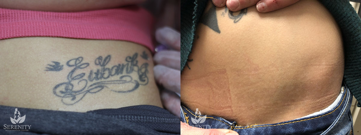 PicoSure Tattoo Removal – Before & After in Bellevue & Seattle