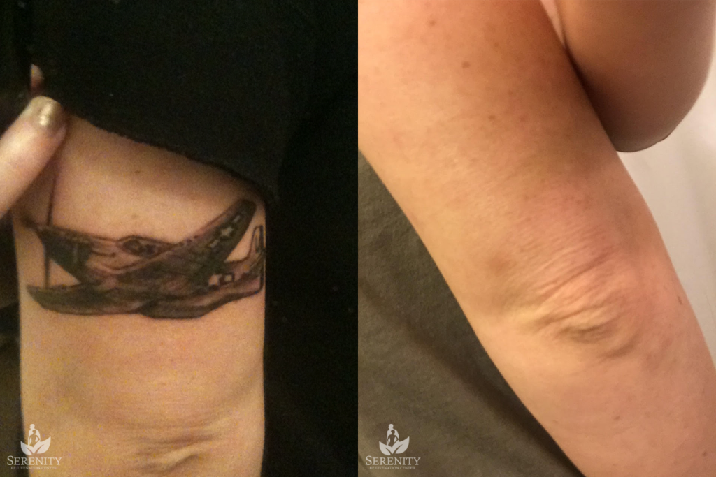 Effective Laser Tattoo Removal in Bellevue & Seattle