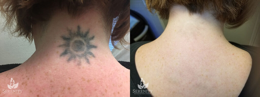 Tattoo Lightening & Removal in Seattle & Bellevue
