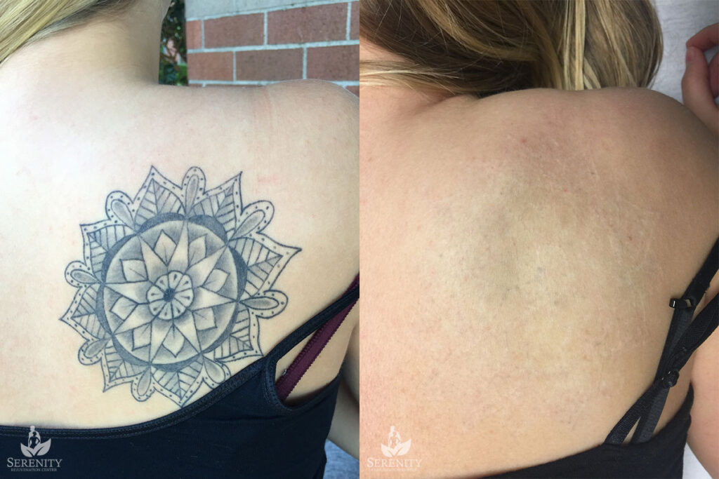 PicoSure Tattoo Removal before and after photo by Dr. Stephen O’Connell in Bellevue, WA