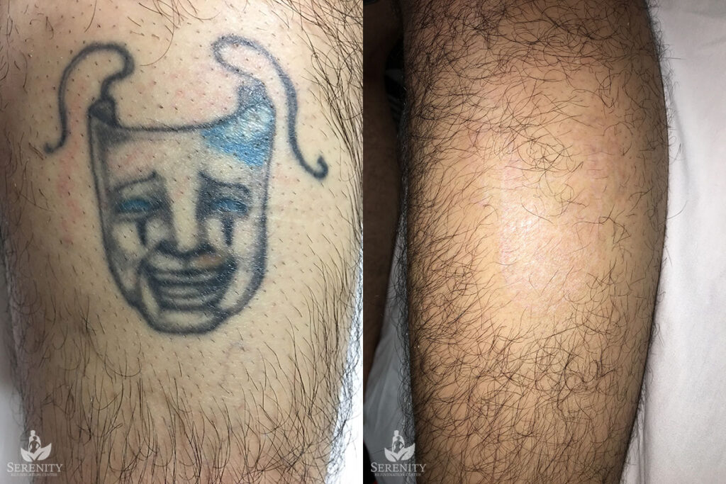 PicoSure Tattoo Removal before and after photo by Dr. Stephen O’Connell in Bellevue, WA