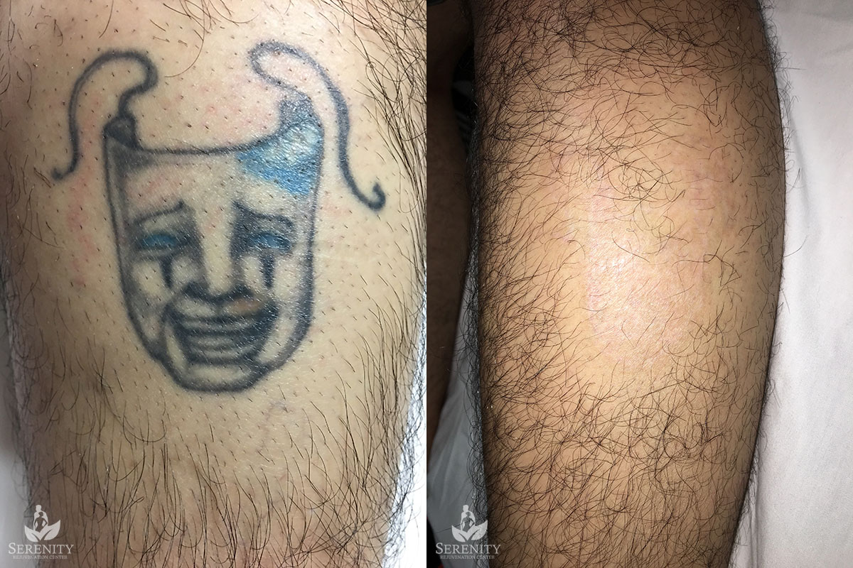 Tattoo Removal Before & After | Bellevue & Seattle