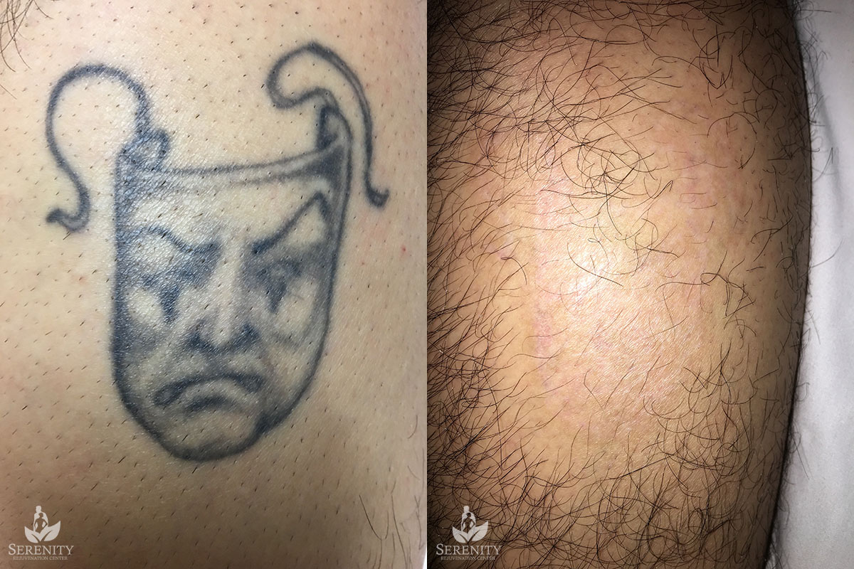 PicoSure Tattoo Removal before and after photo by Dr. Stephen O’Connell in Bellevue, WA