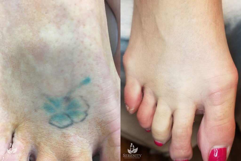 PicoSure Tattoo Removal before and after photo by Dr. Stephen O’Connell in Bellevue, WA