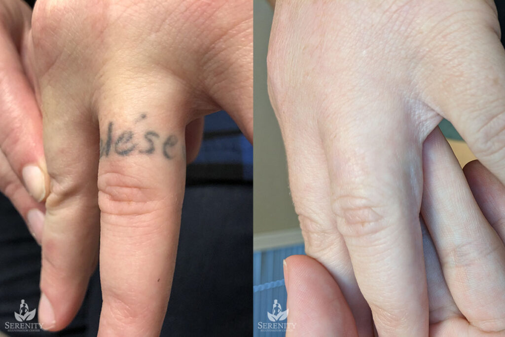 PicoSure Tattoo Removal before and after photo by Dr. Stephen O’Connell in Bellevue, WA