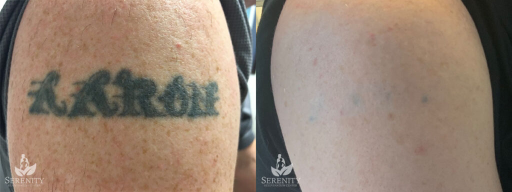 Unwanted Tattoo Removal in Seattle & Bellevue